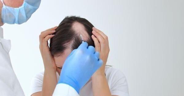 脱发患者患炎性关节炎的风险更高